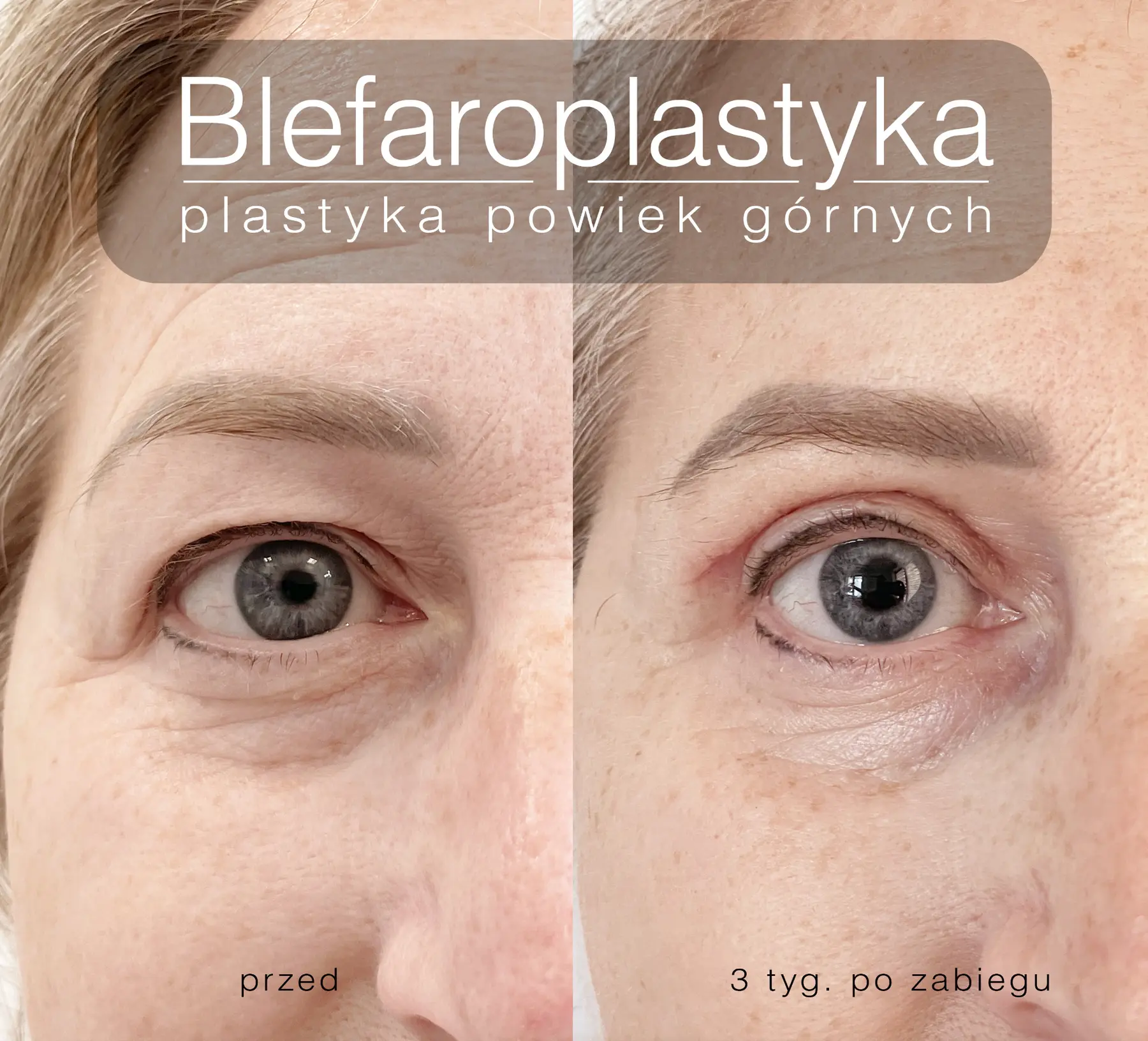 Blefaroplastyka powiek górnych wykonana przez dr Ninę Moroz-Majewską — porównanie przed zabiegiem i trzy tygodnie po zabiegu