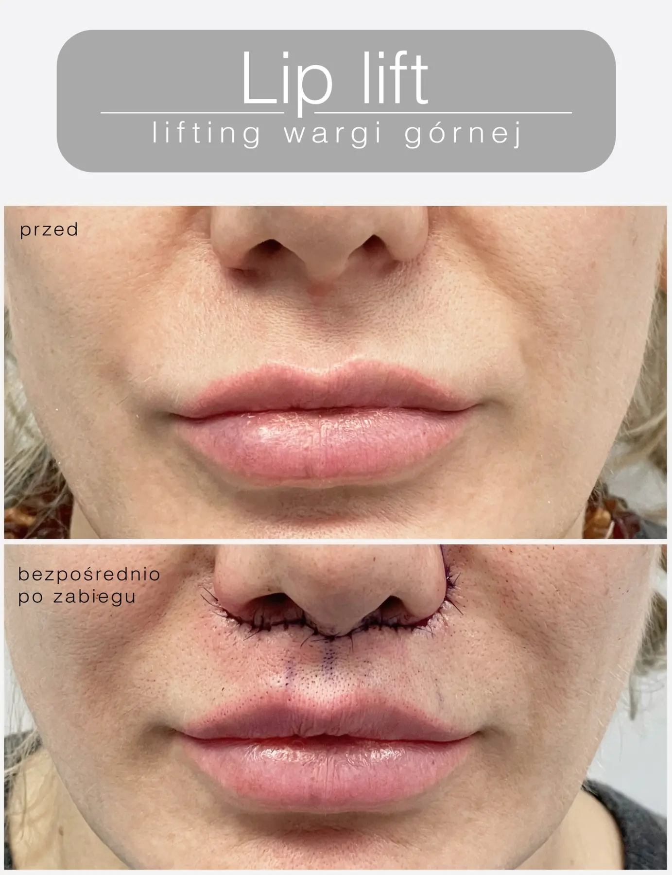 Lip lift wykonany przez dr Ninę Moroz-Majewską — porównanie przed zabiegiem i bezpośrednio po zabiegu z widocznymi szwami